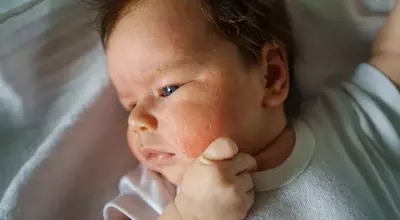 Common Rashes in Children: Identification and Management