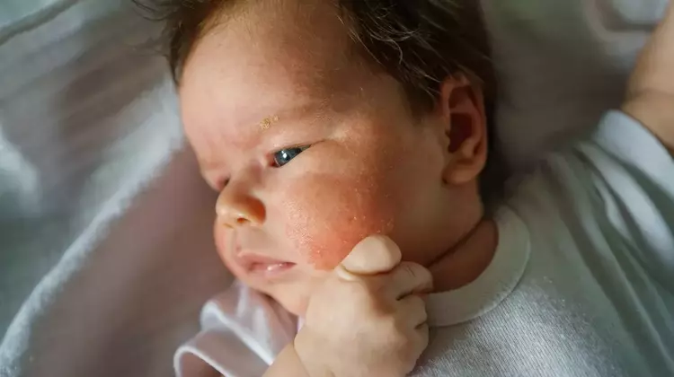Common Rashes in Children: Identification and Management